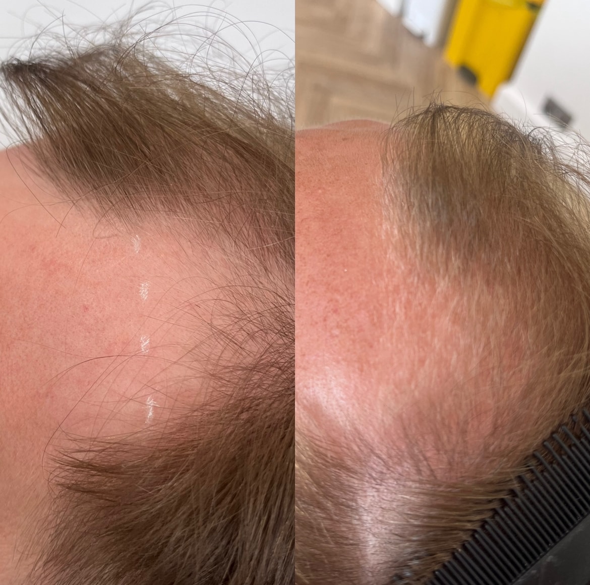 Before and after: microneedling scalp treatment after 6 months at The PMU Clinic