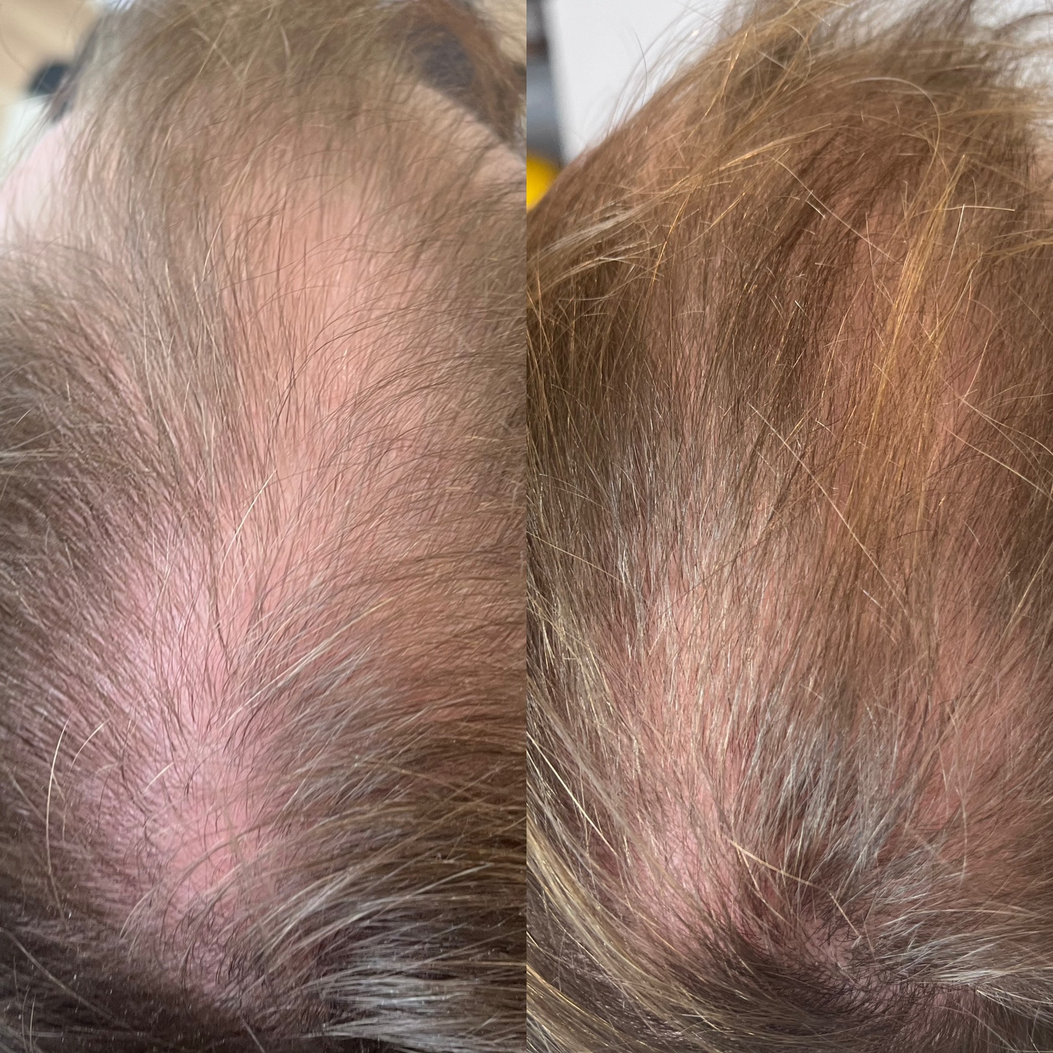 Before and after: microneedling scalp treatment after 9 months at The PMU Clinic