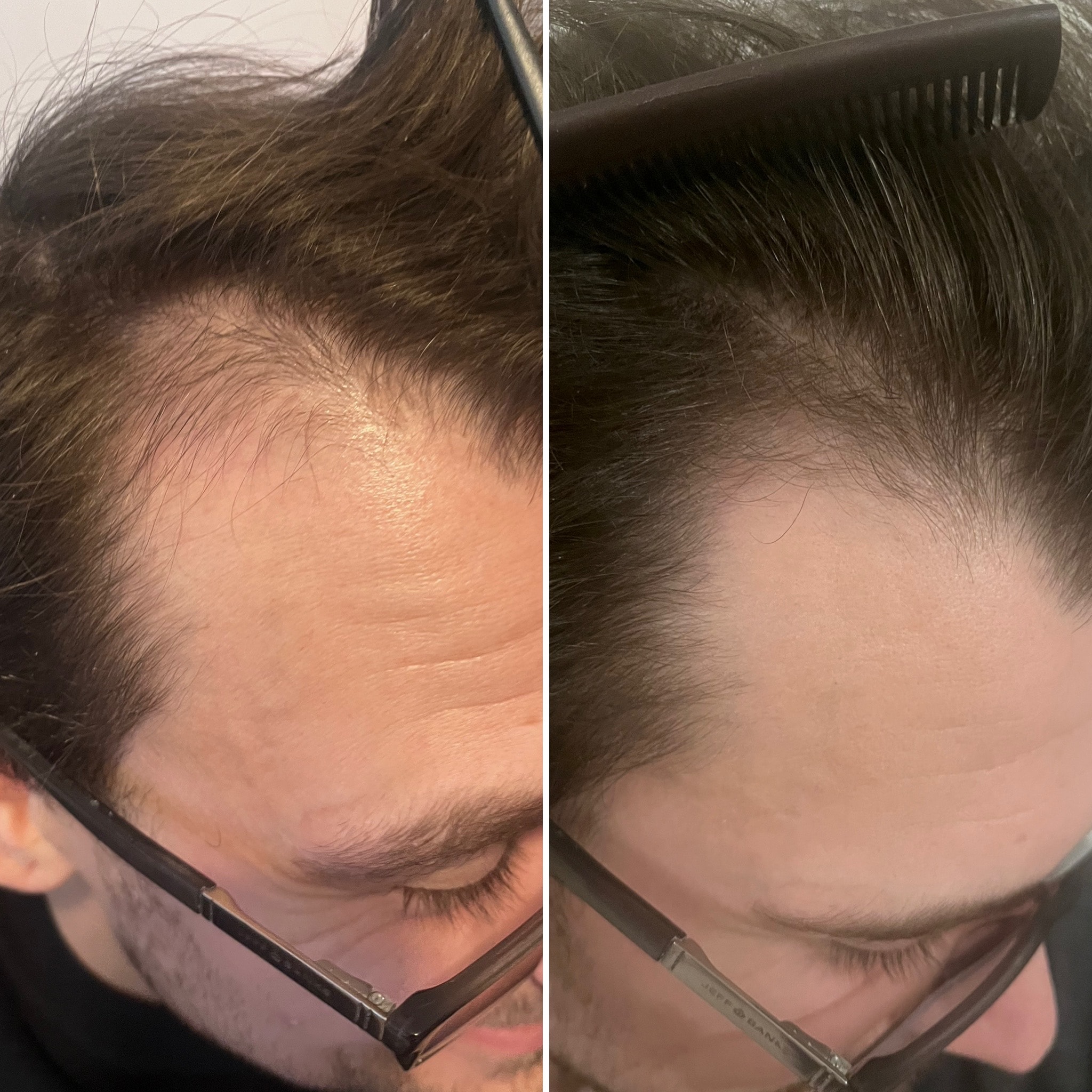 Before and after: microneedling at 3 months with 360 trichological treatment plan at The PMU Clinic