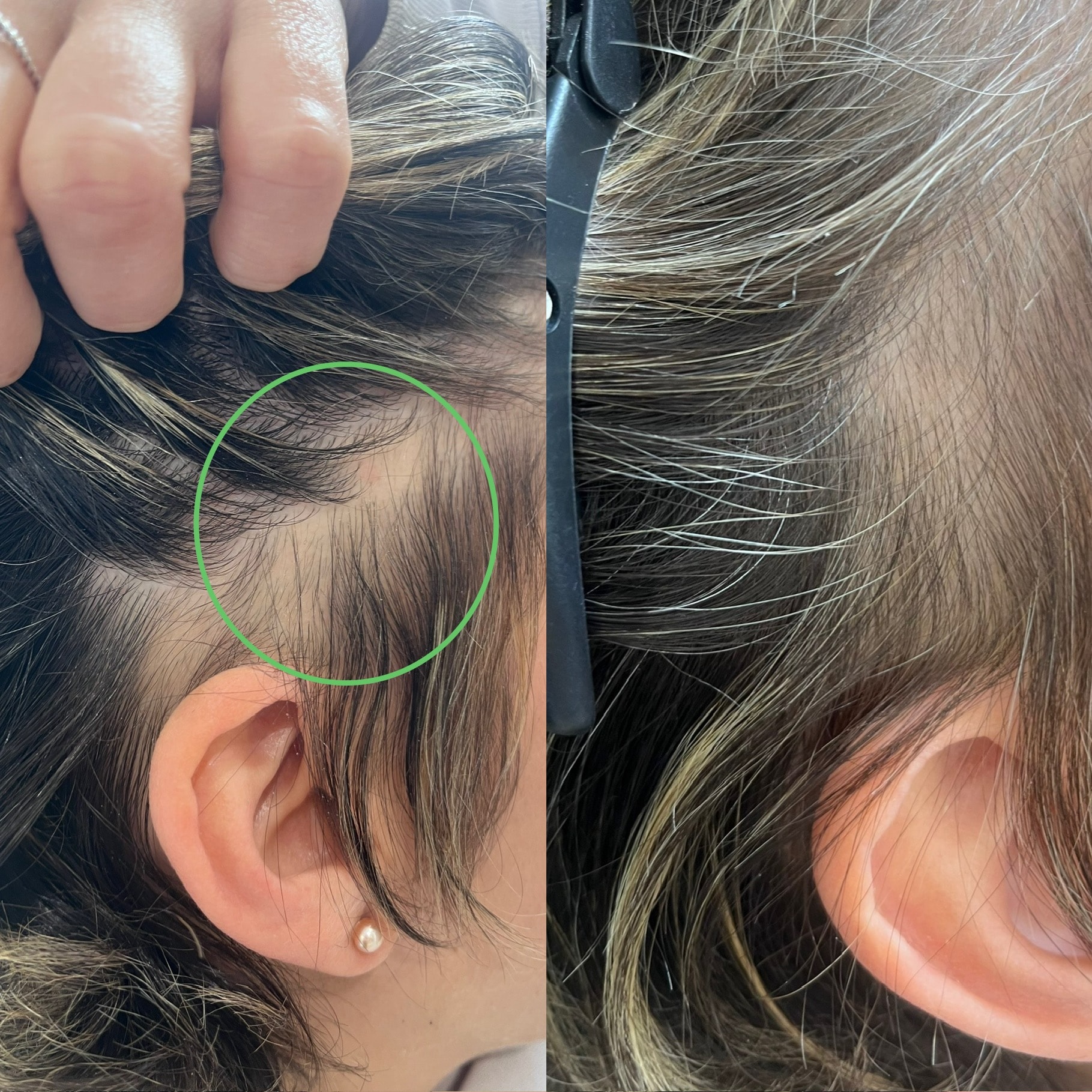 Before and after: microneedling at 4 months with 360 trichological treatment plan at The PMU Clinic