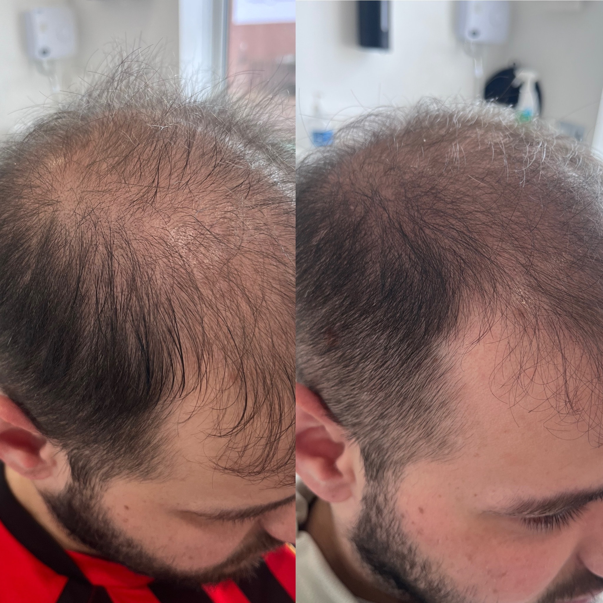 Before and after: microneedling at 6 months with 360 trichological treatment plan at The PMU Clinic