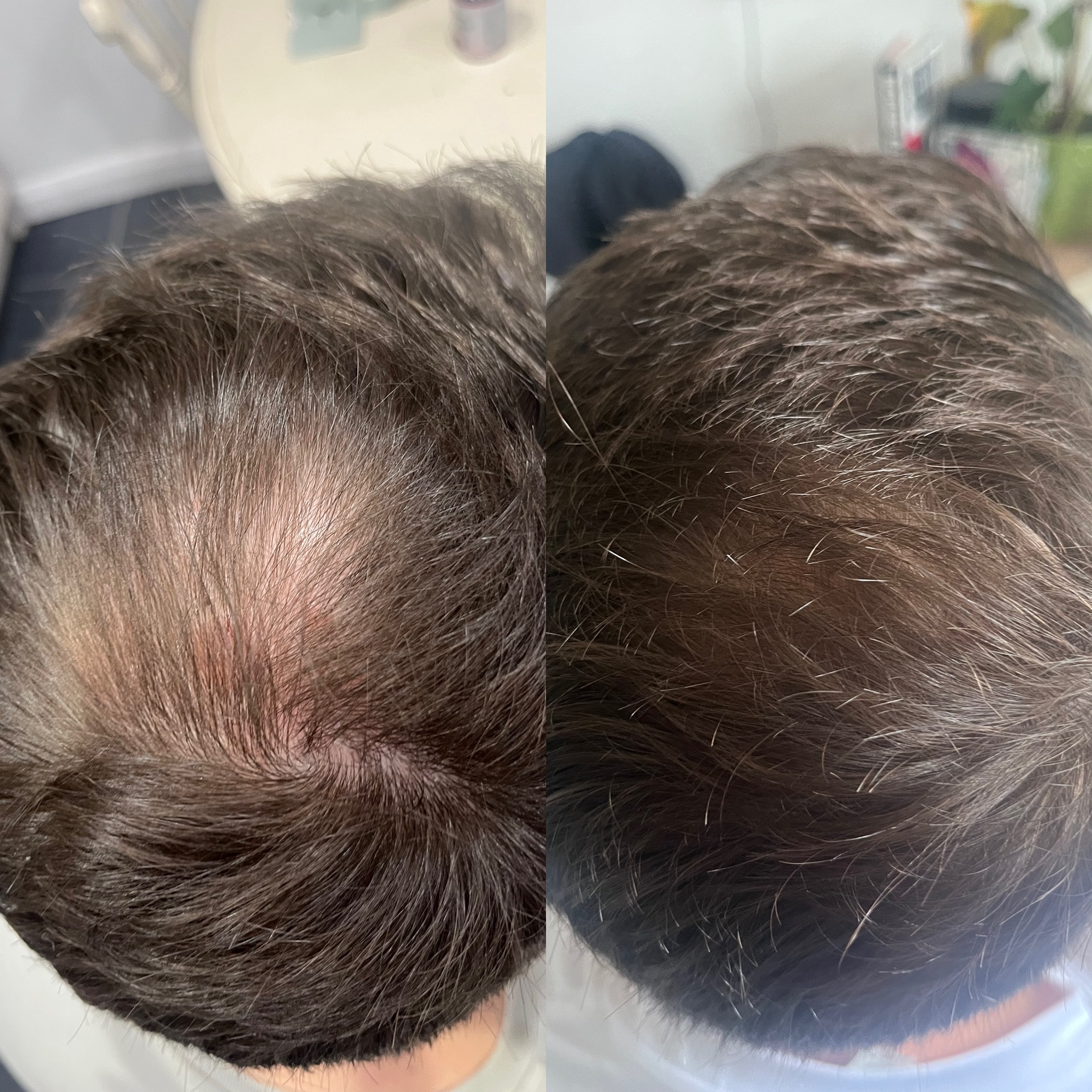 Before and after: polynucleotides and microneedling combined treatment with 360 trichological treatment plan at The PMU Clinic
