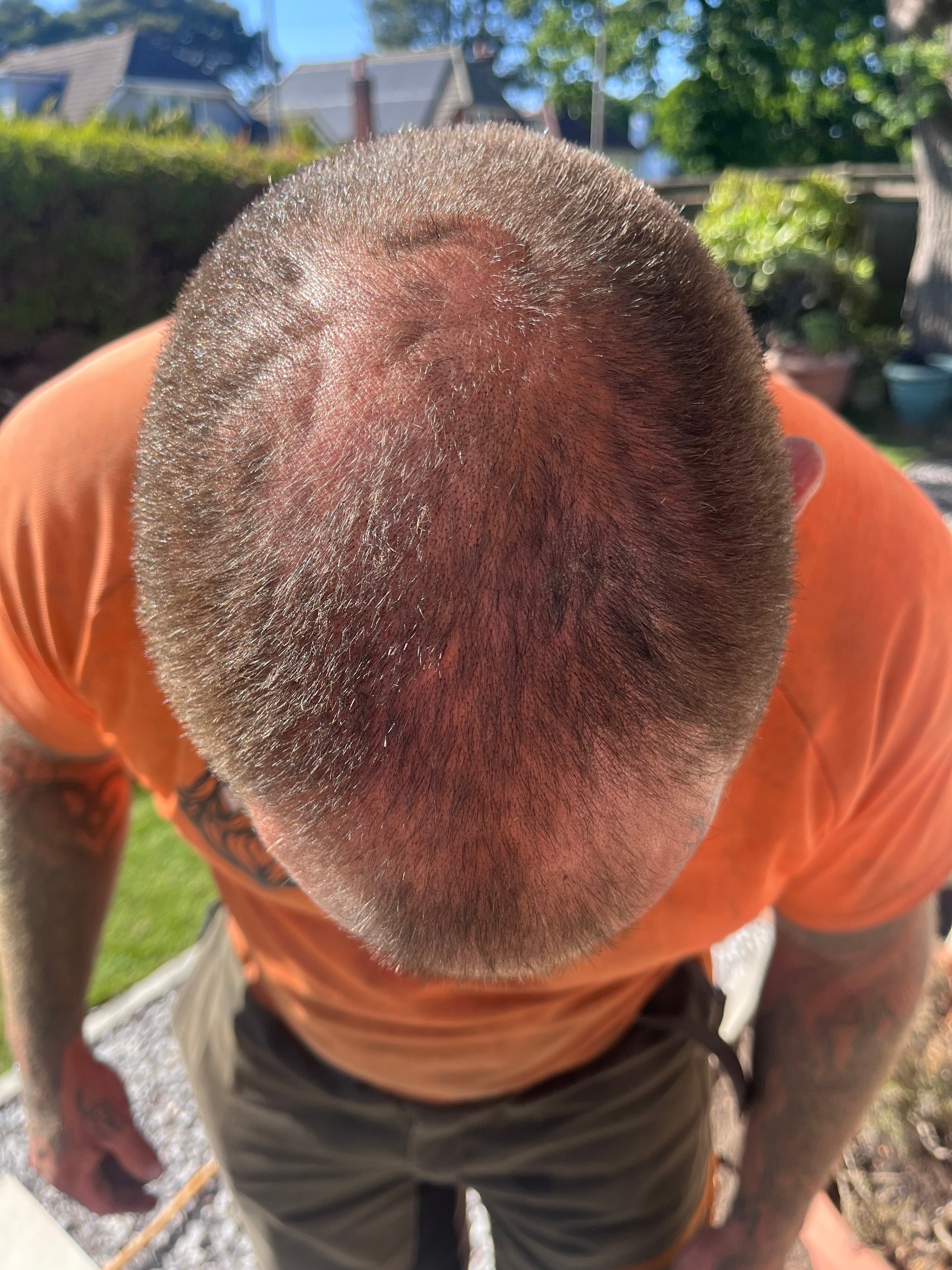 After — significantly improved density following 360 trichological treatment plan