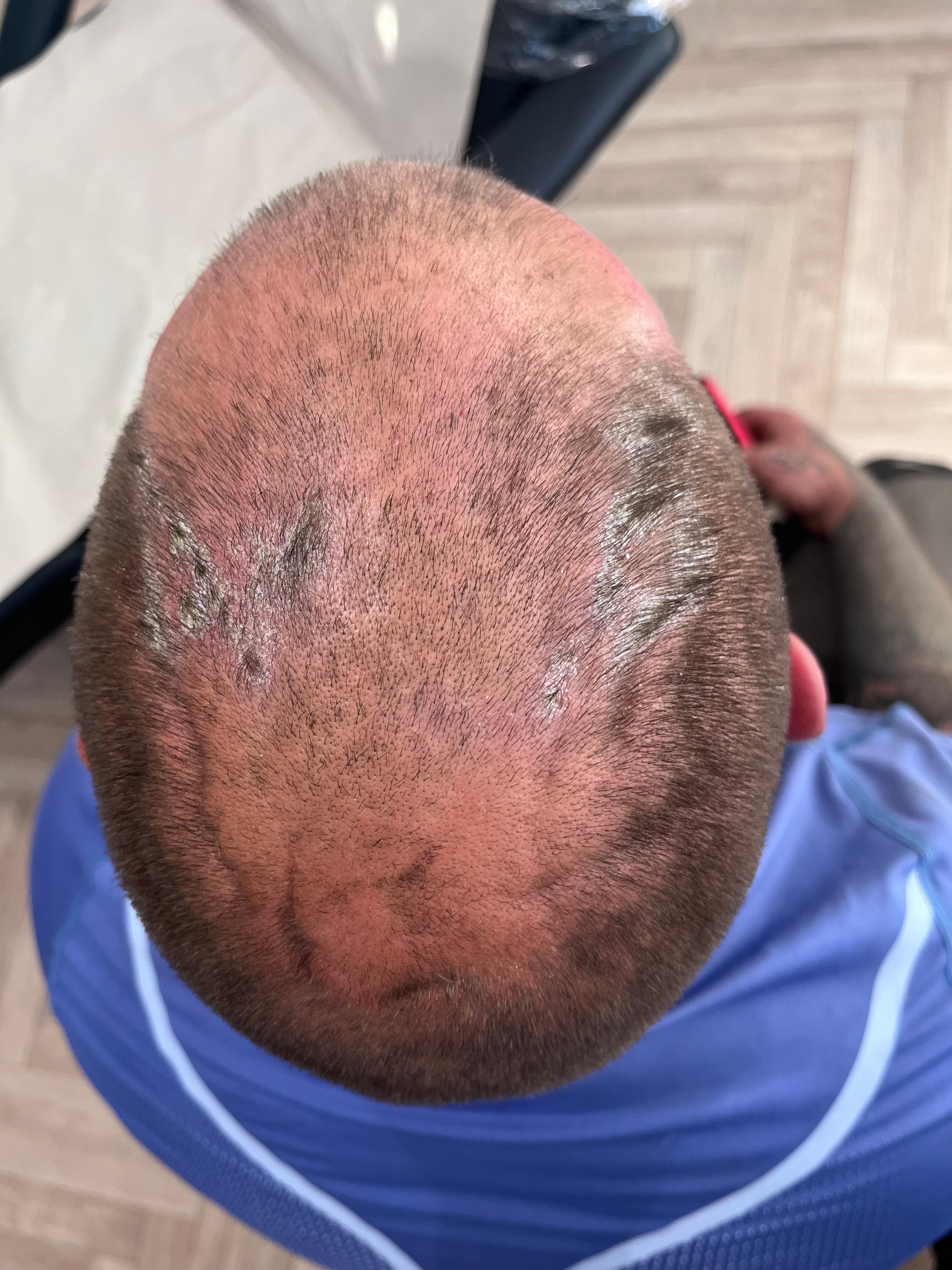 Before — scalp condition prior to trichological treatment plan