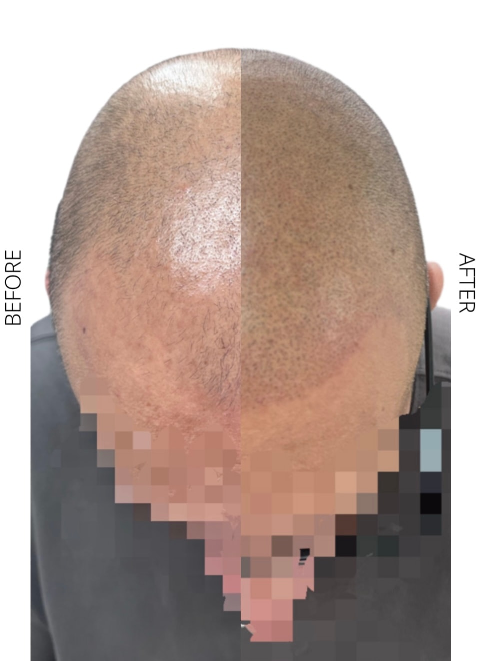 Full SMP before and after result at The PMU Clinic