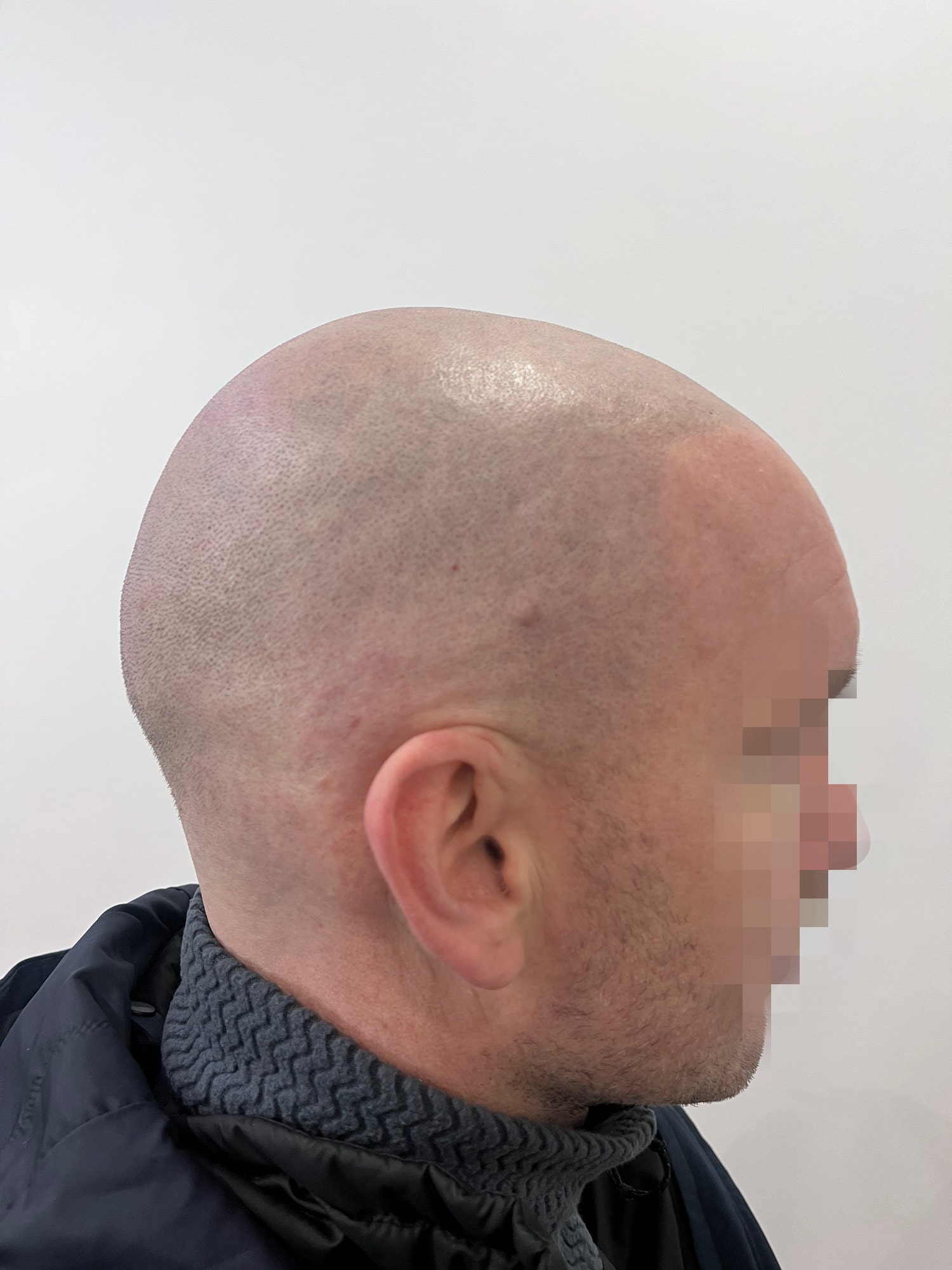 Full Scalp SMP healed result side profile at The PMU Clinic