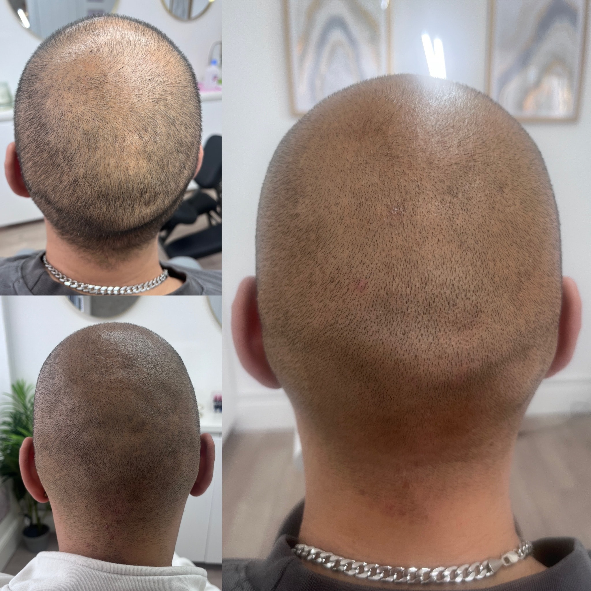 Full SMP rear view before and after result at The PMU Clinic