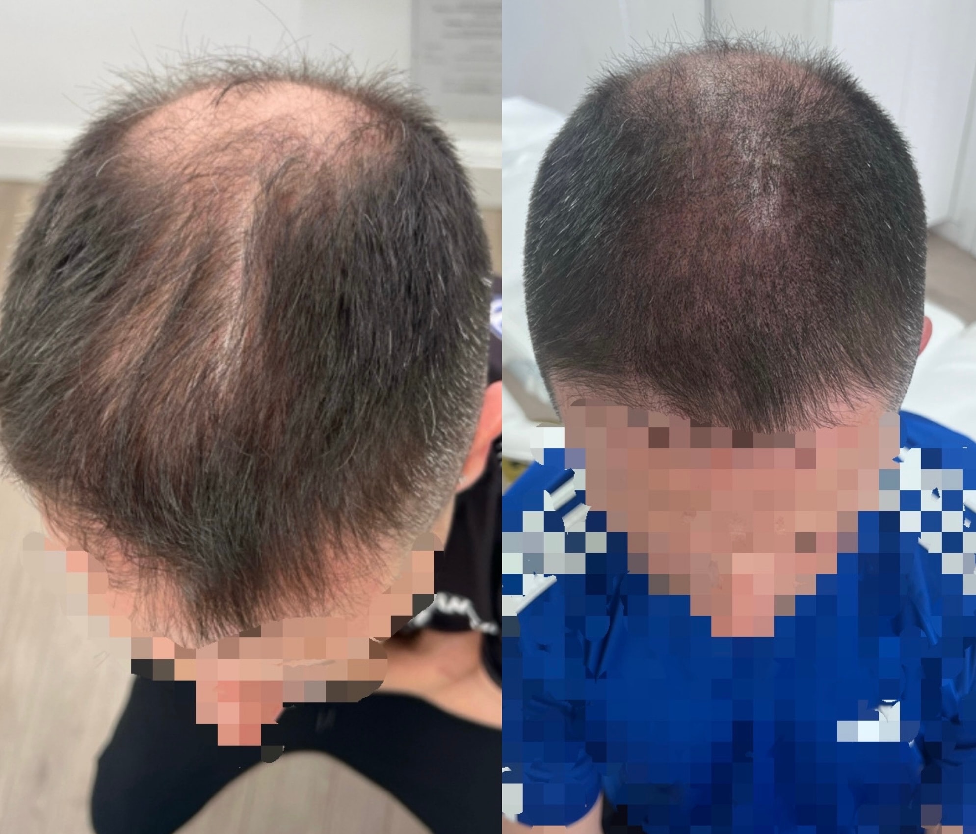Hair density SMP before and after result at The PMU Clinic