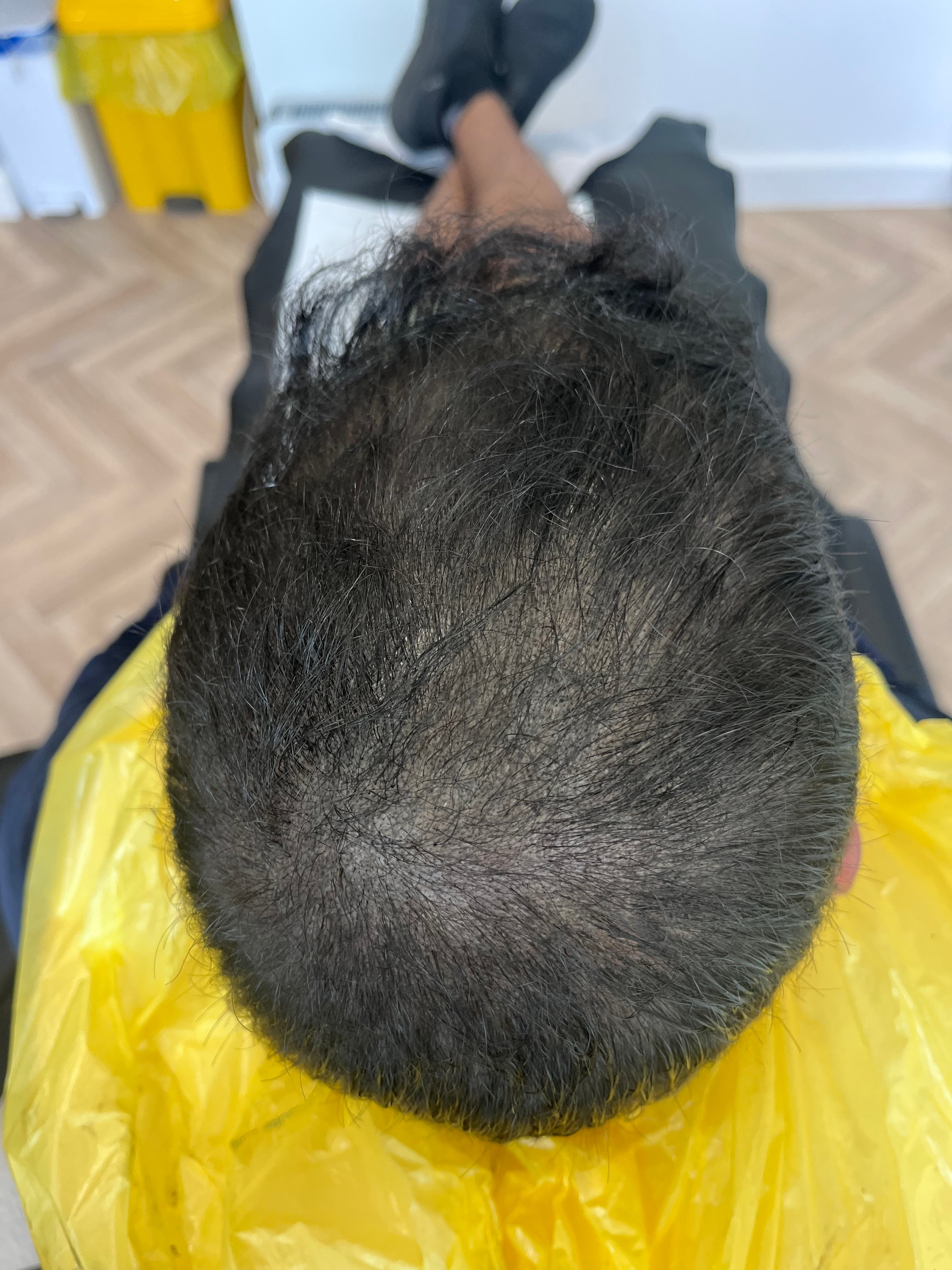 Hair Density SMP after treatment result