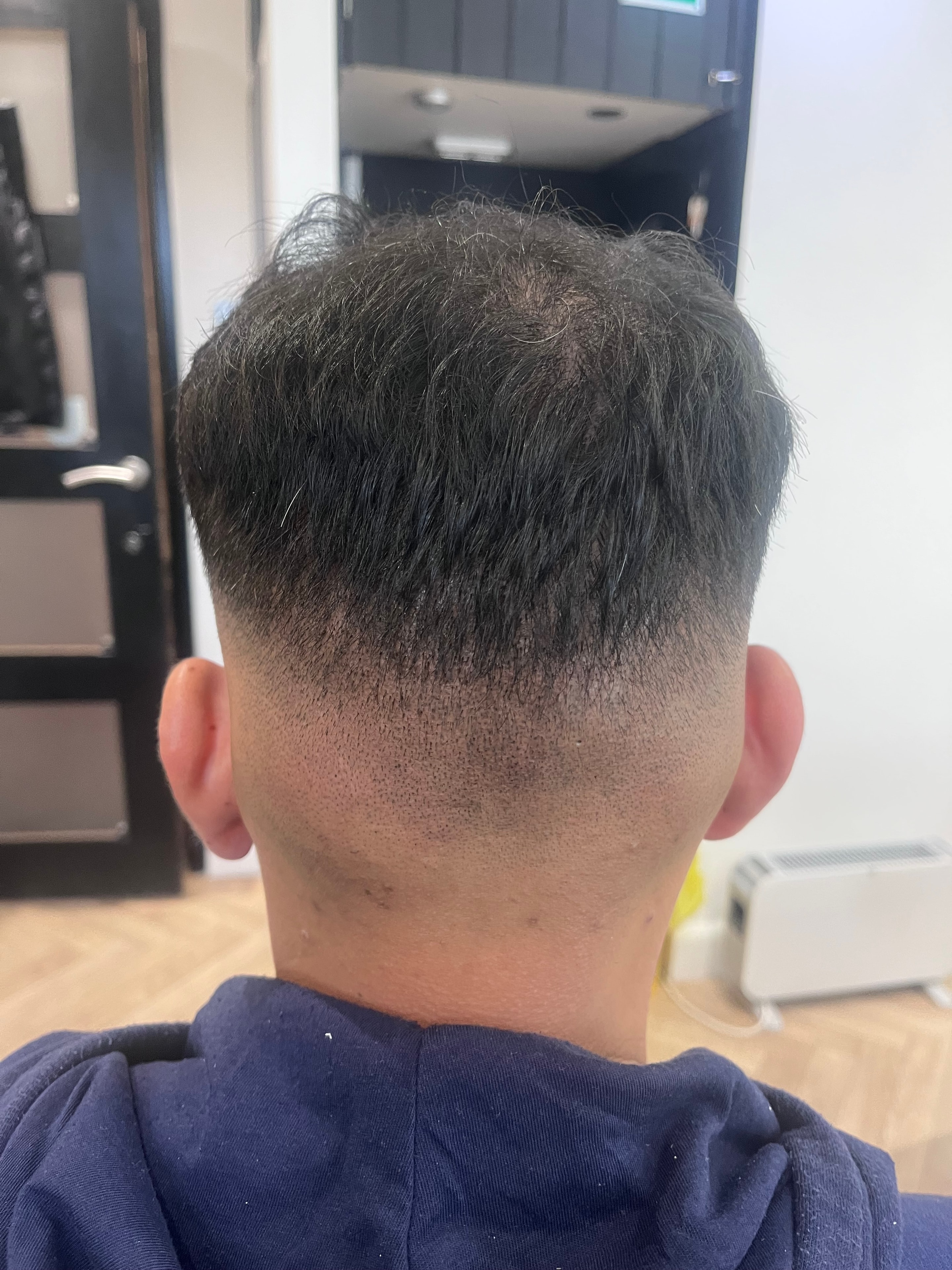 After Follicular Unit Excision SMP blending treatment at The PMU Clinic