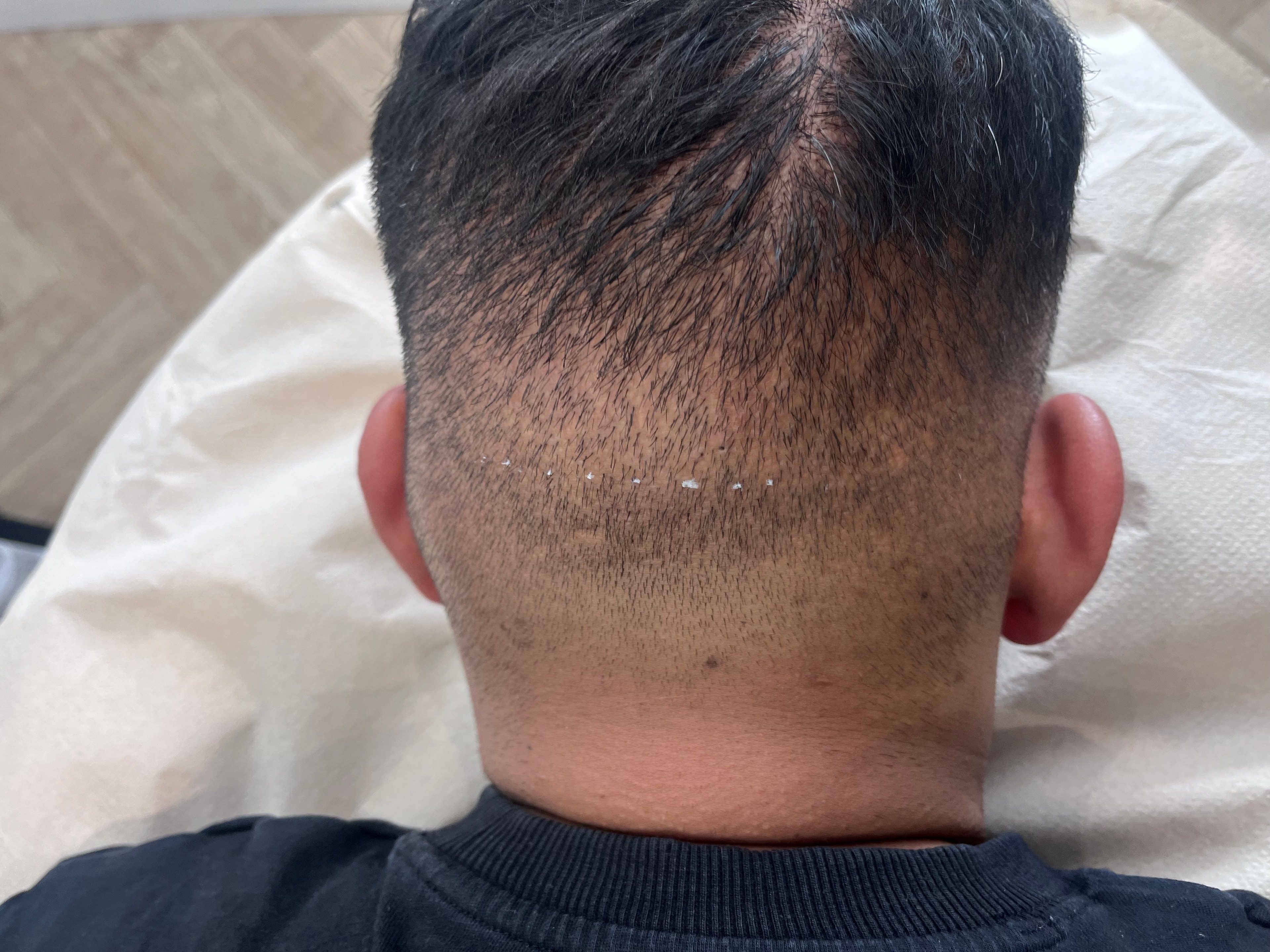 Before Follicular Unit Excision SMP blending treatment at The PMU Clinic