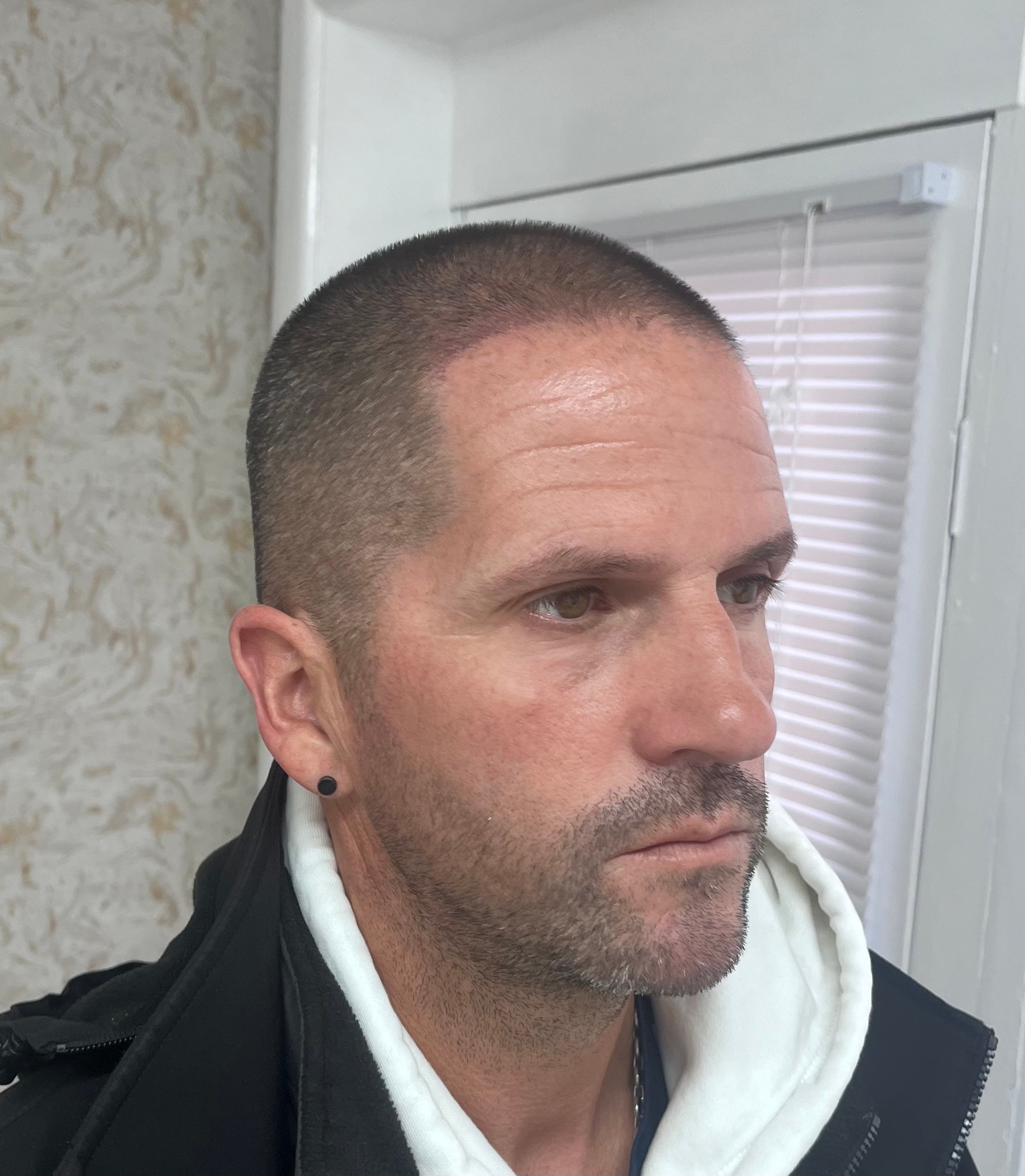 Hair Line SMP healed result at The PMU Clinic