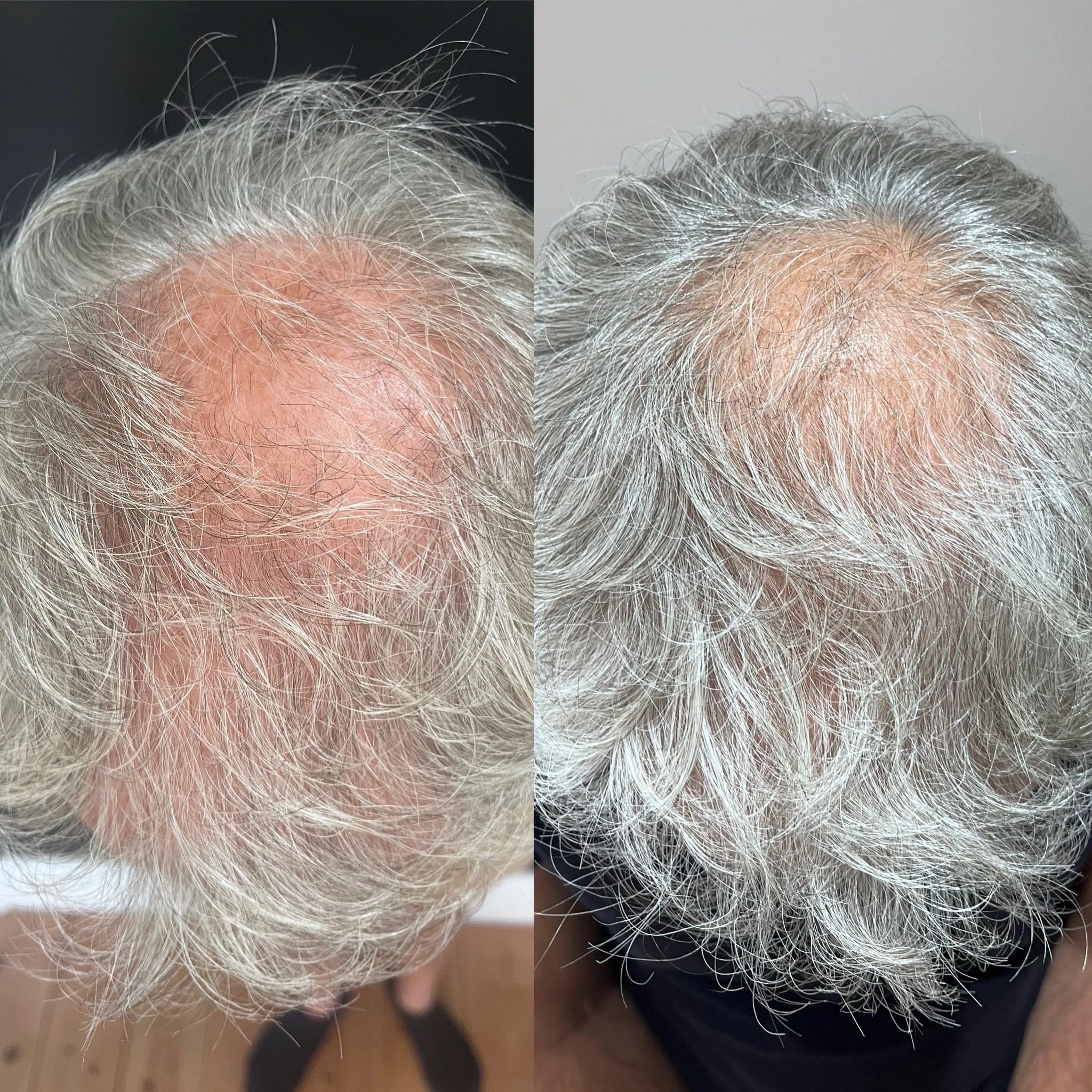 Before and after: scalp and hair restoration following Polynucleotide treatment at The PMU Clinic